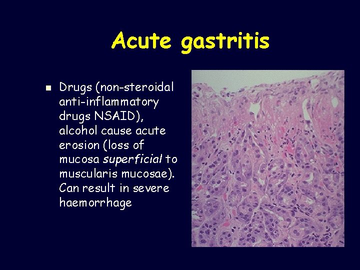 Acute gastritis n Drugs (non-steroidal anti-inflammatory drugs NSAID), alcohol cause acute erosion (loss of