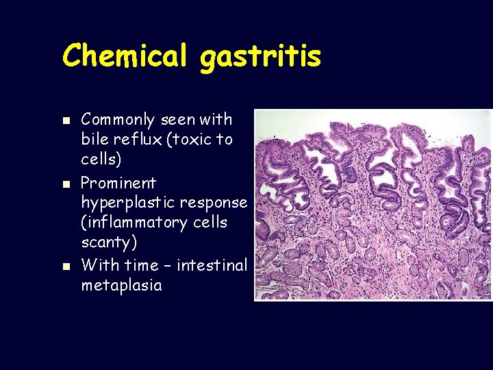 Chemical gastritis n n n Commonly seen with bile reflux (toxic to cells) Prominent