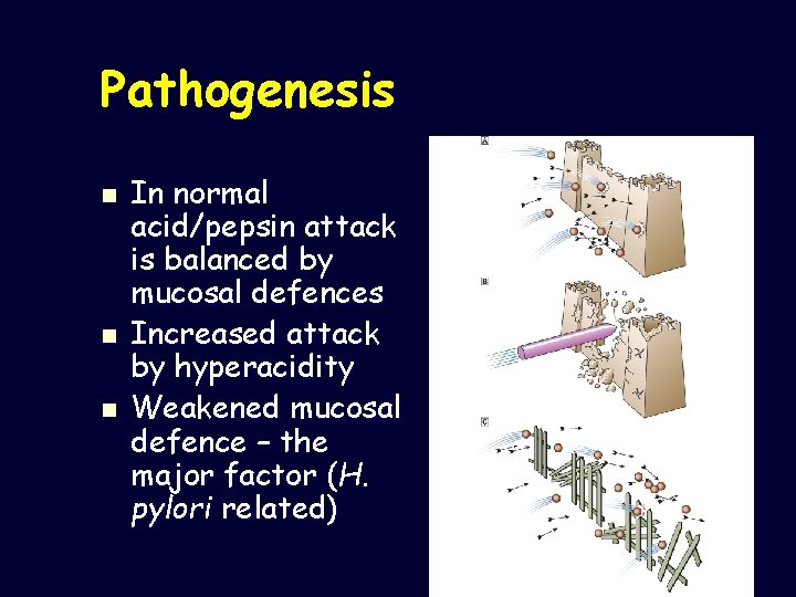 Pathogenesis n n n In normal acid/pepsin attack is balanced by mucosal defences Increased
