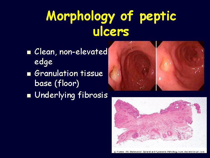 Morphology of peptic ulcers n n n Clean, non-elevated edge Granulation tissue base (floor)