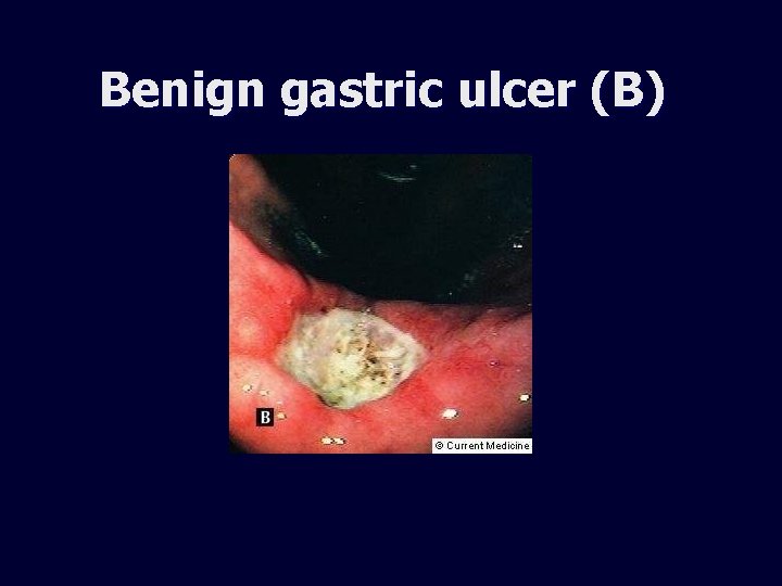Benign gastric ulcer (B) 