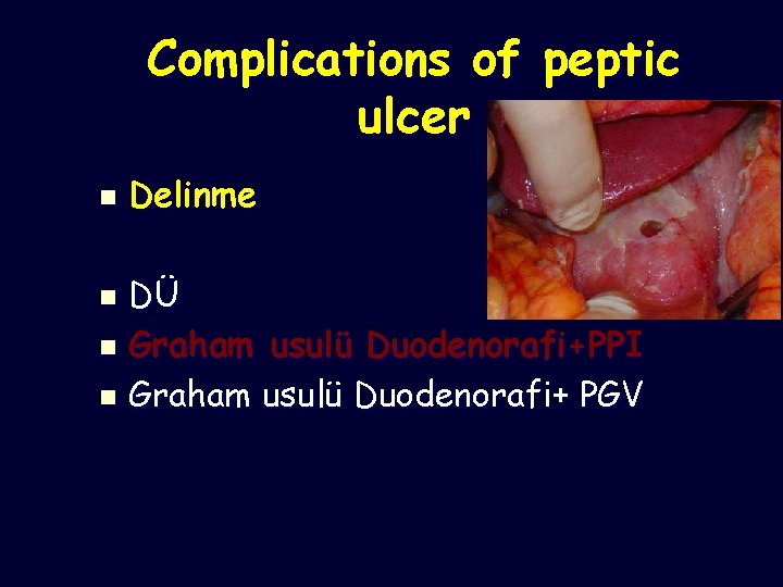 Complications of peptic ulcer n Delinme DÜ n Graham usulü Duodenorafi+PPI n Graham usulü