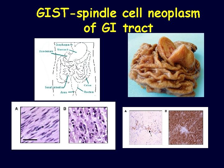 GIST-spindle of GI cell neoplasm tract 
