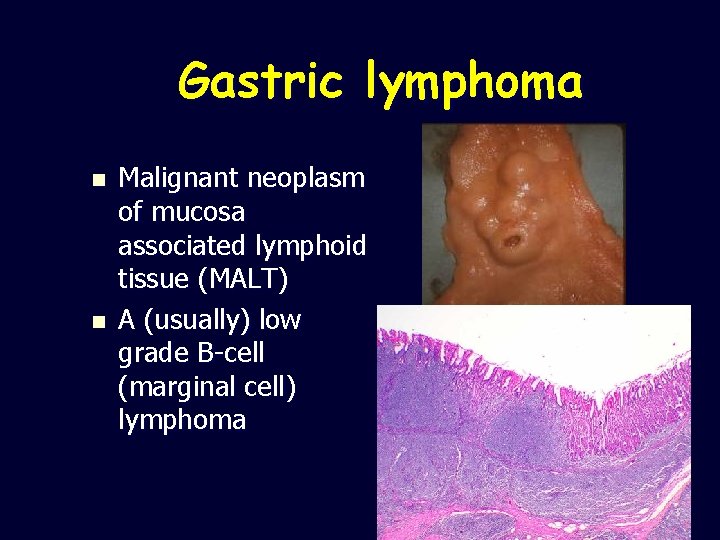 Gastric lymphoma n n Malignant neoplasm of mucosa associated lymphoid tissue (MALT) A (usually)
