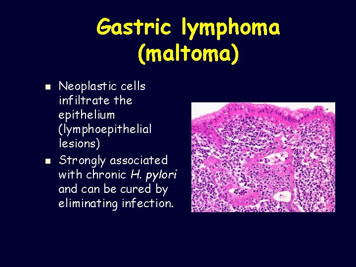 Gastric lymphoma (maltoma) n n Neoplastic cells infiltrate the epithelium (lymphoepithelial lesions) Strongly associated