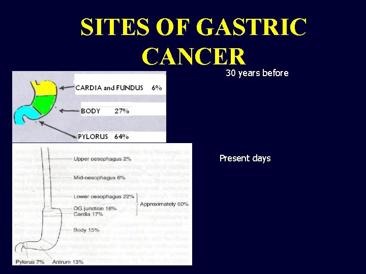 SITES OF GASTRIC CANCER 30 years before Present days 