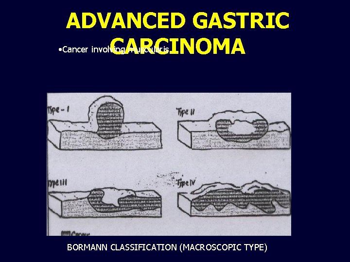 ADVANCED GASTRIC • Cancer involving muscularis CARCINOMA BORMANN CLASSIFICATION (MACROSCOPIC TYPE) 