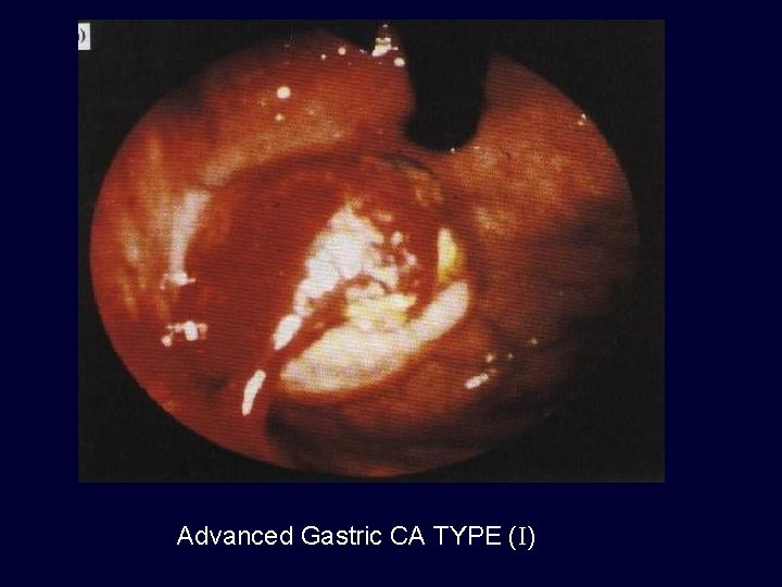 Advanced Gastric CA TYPE (I) 