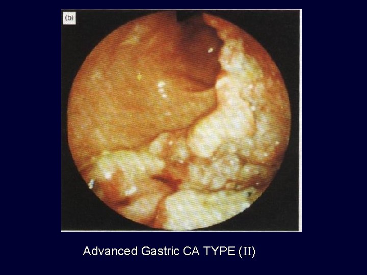 Advanced Gastric CA TYPE (II) 