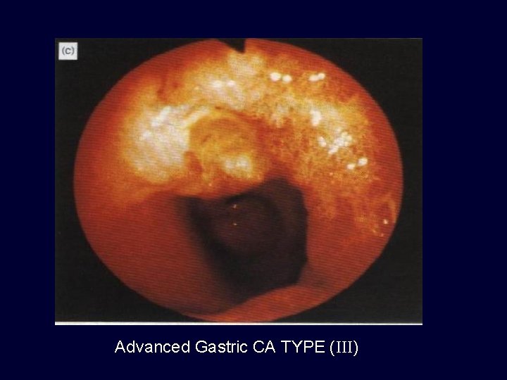 Advanced Gastric CA TYPE (III) 