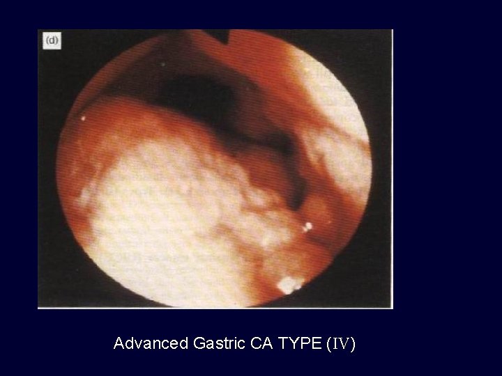 Advanced Gastric CA TYPE (IV) 