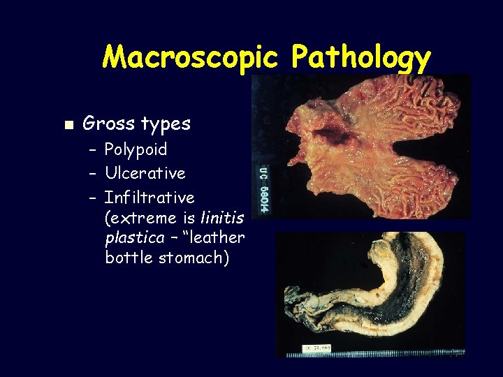 Macroscopic Pathology n Gross types – – – Polypoid Ulcerative Infiltrative (extreme is linitis