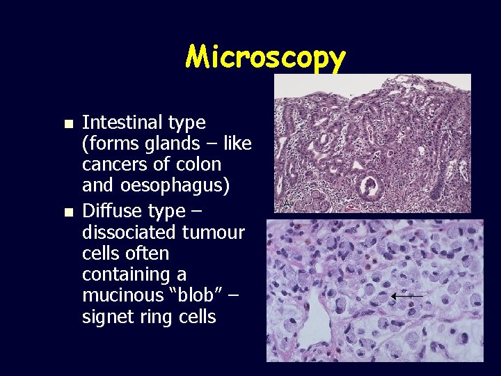 Microscopy n n Intestinal type (forms glands – like cancers of colon and oesophagus)