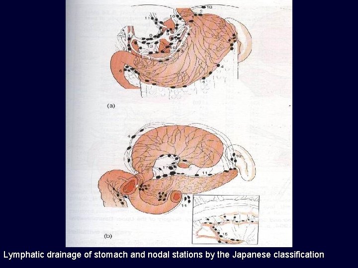 Lymphatic drainage of stomach and nodal stations by the Japanese classification 