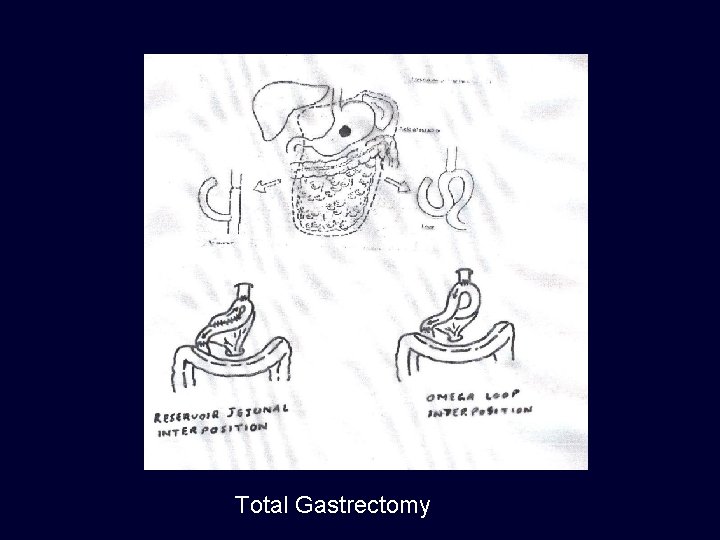 Total Gastrectomy 