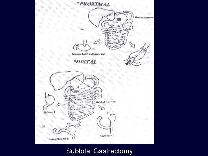 Subtotal Gastrectomy 