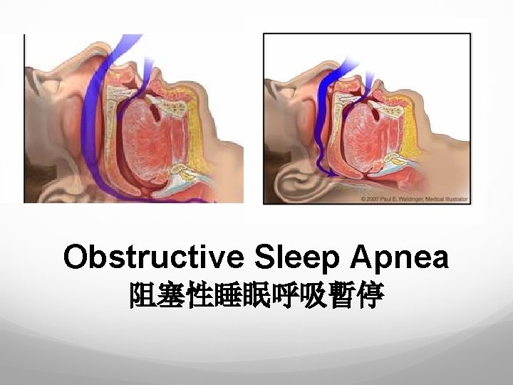 Obstructive Sleep Apnea 阻塞性睡眠呼吸暫停 