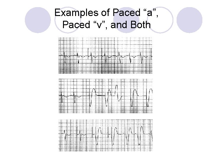 Examples of Paced “a”, Paced “v”, and Both 