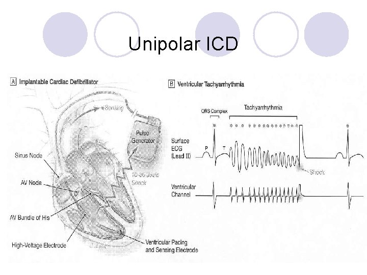 Unipolar ICD 