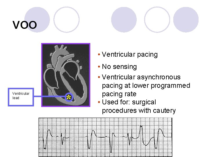 VOO • Ventricular pacing Ventricular lead * • No sensing • Ventricular asynchronous pacing