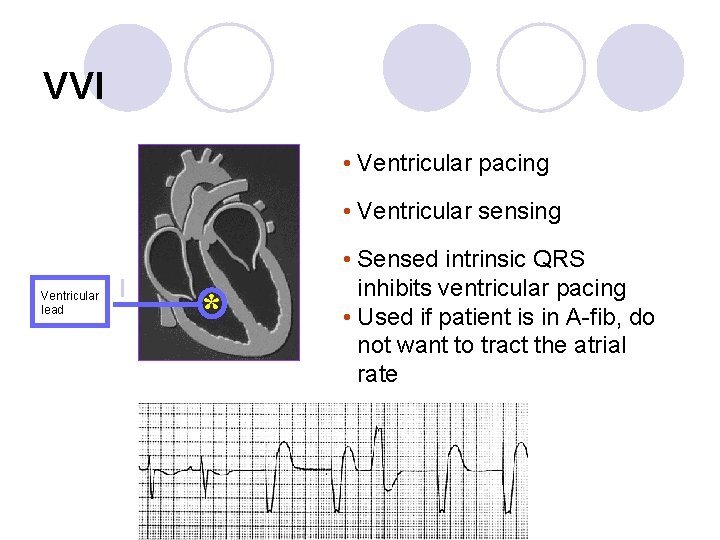 VVI • Ventricular pacing • Ventricular sensing Ventricular lead I * • Sensed intrinsic