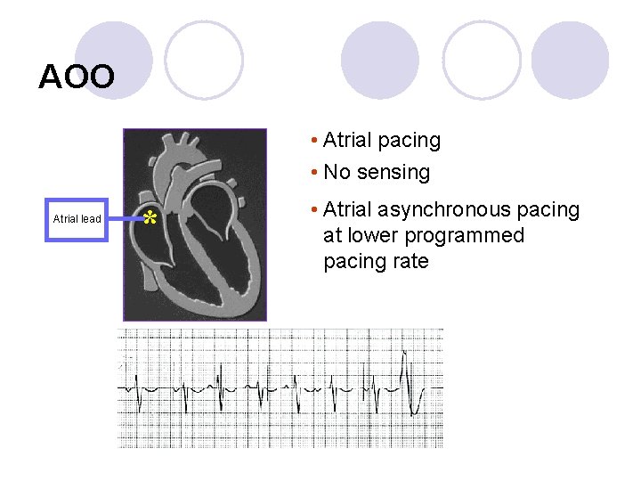 AOO • Atrial pacing • No sensing Atrial lead * • Atrial asynchronous pacing