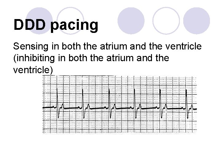 DDD pacing Sensing in both the atrium and the ventricle (inhibiting in both the