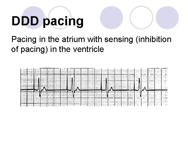 DDD pacing Pacing in the atrium with sensing (inhibition of pacing) in the ventricle