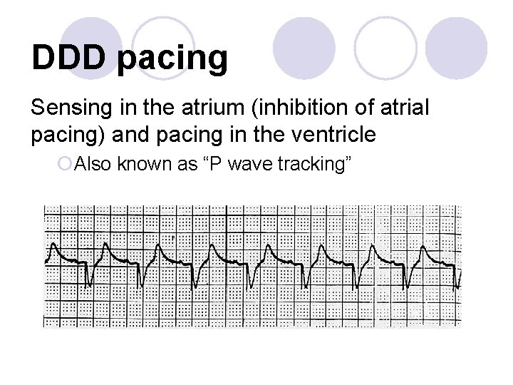 DDD pacing Sensing in the atrium (inhibition of atrial pacing) and pacing in the