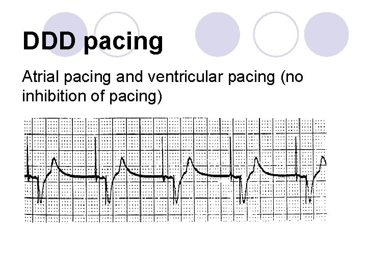 DDD pacing Atrial pacing and ventricular pacing (no inhibition of pacing) 