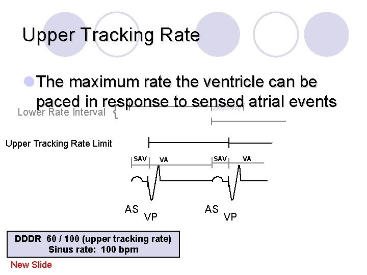 Upper Tracking Rate l The maximum rate the ventricle can be paced in response