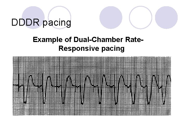 DDDR pacing Example of Dual-Chamber Rate. Responsive pacing 