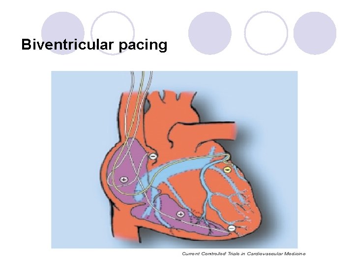 Biventricular pacing 