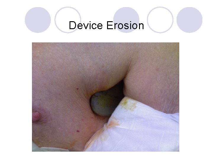 Device Erosion 