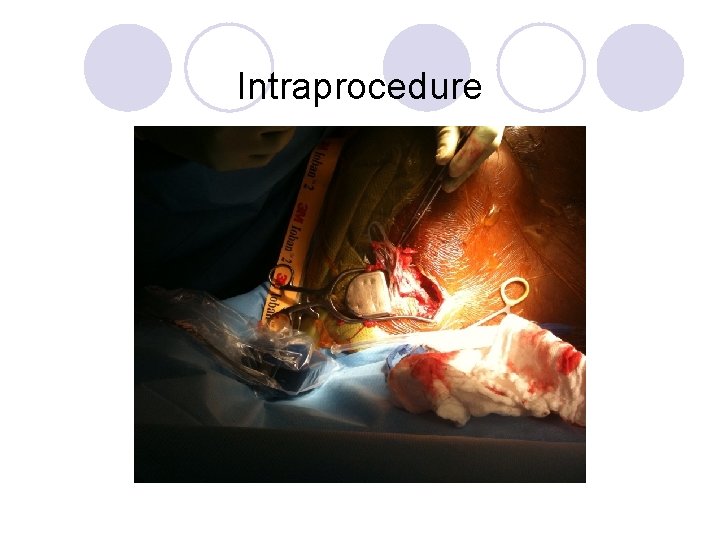 Intraprocedure 