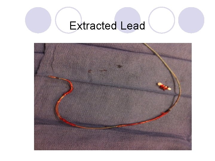 Extracted Lead 