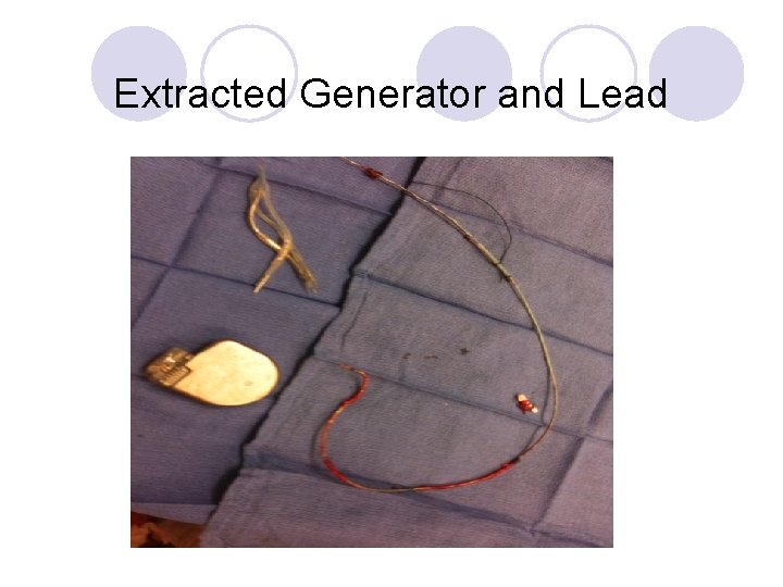 Extracted Generator and Lead 