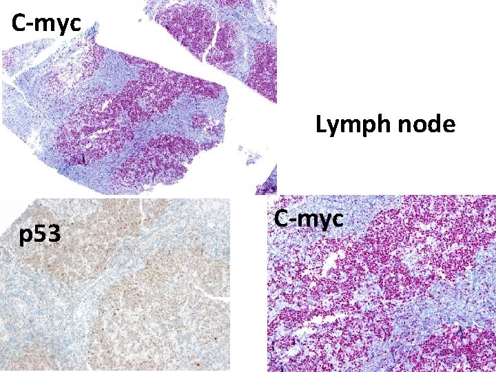 C-myc Lymph node p 53 C-myc 