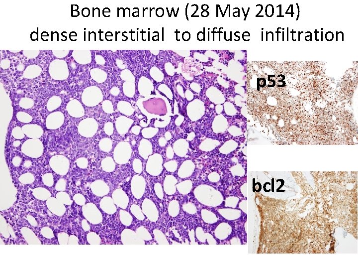 Bone marrow (28 May 2014) dense interstitial to diffuse infiltration p 53 bcl 2