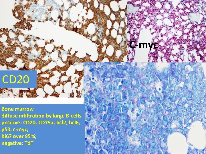 C-myc CD 20 Bone marrow diffuse infiltration by large B-cells positive: CD 20, CD