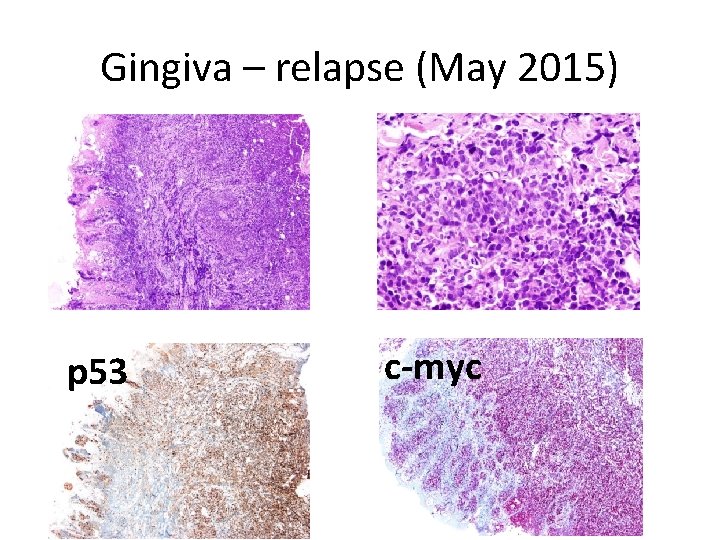 Gingiva – relapse (May 2015) p 53 c-myc 