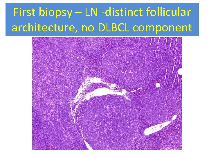 First biopsy – LN -distinct follicular architecture, no DLBCL component 