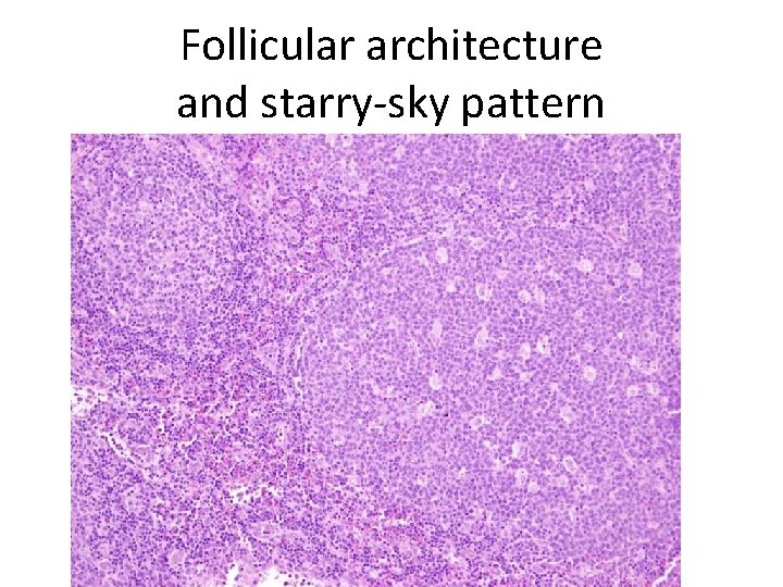 Follicular architecture and starry-sky pattern 