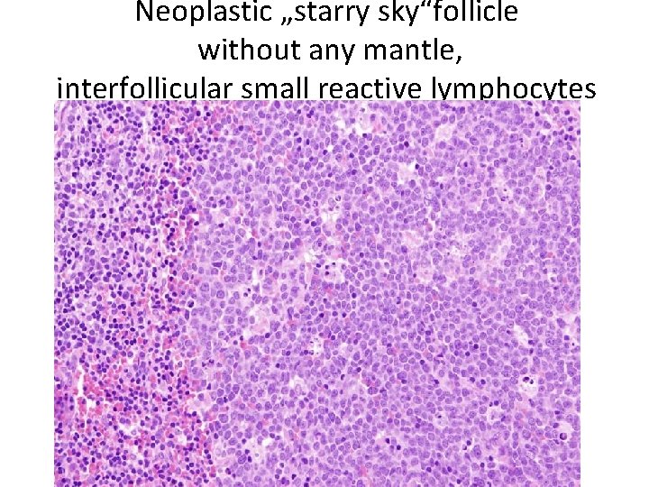 Neoplastic „starry sky“follicle without any mantle, interfollicular small reactive lymphocytes 