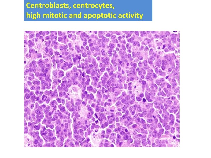 Centroblasts, centrocytes, high mitotic and apoptotic activity 