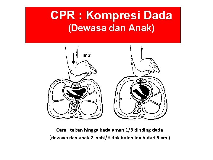 CPR : Kompresi Dada (Dewasa dan Anak) Cara : tekan hingga kedalaman 1/3 dinding