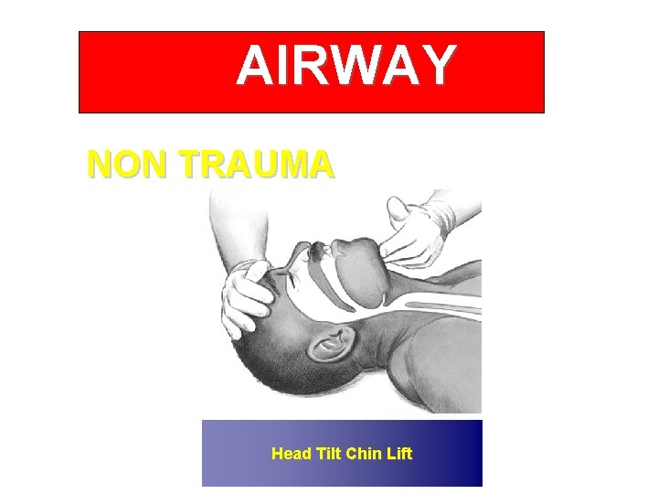 AIRWAY NON TRAUMA Head Tilt Chin Lift 