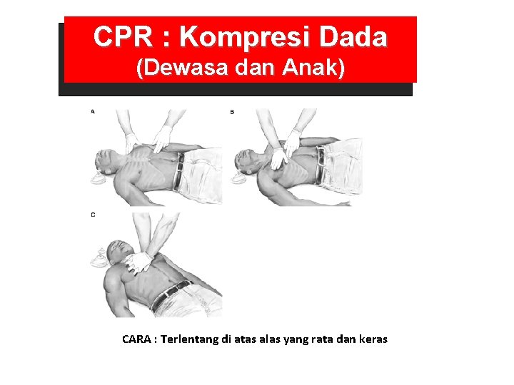 CPR : Kompresi Dada (Dewasa dan Anak) CARA : Terlentang di atas alas yang