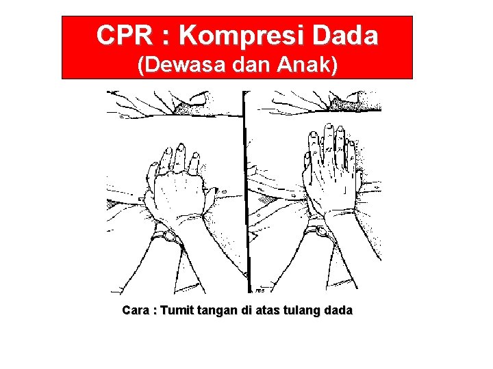 CPR : Kompresi Dada (Dewasa dan Anak) Cara : Tumit tangan di atas tulang