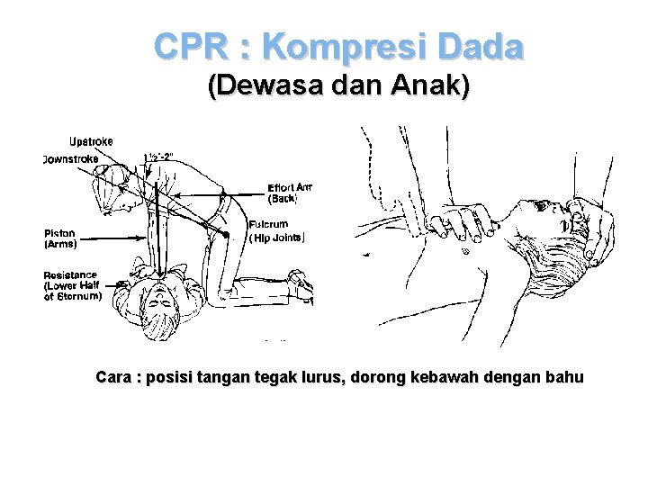 CPR : Kompresi Dada (Dewasa dan Anak) Cara : posisi tangan tegak lurus, dorong